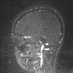 Cerebral tuberculosis with dural sinus invasion (Radiopaedia 60353-68090 Sagittal MRV 110).jpg