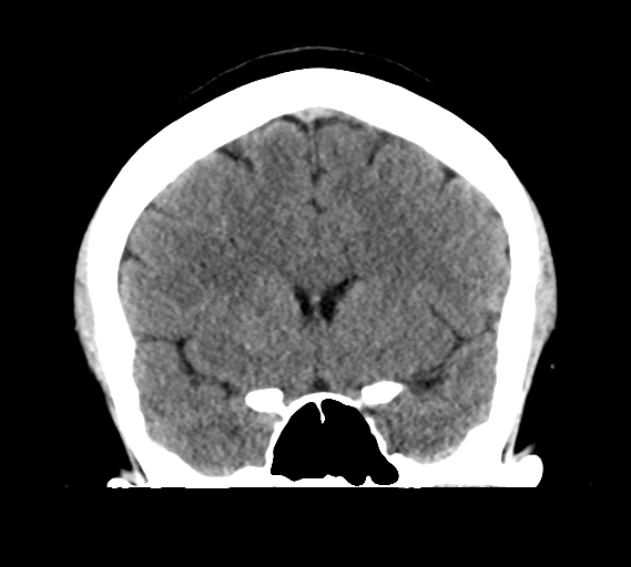 File:Cerebral venous infarct related to dural venous sinus thromboses (Radiopaedia 35292-36804 Coronal non-contrast 14).png
