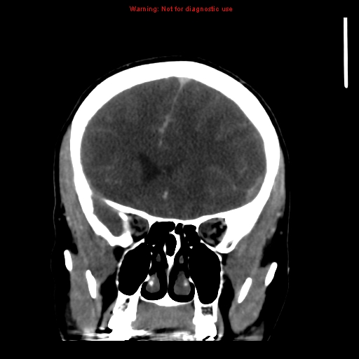 Cerebral venous infarction (Radiopaedia 12404-20735 B 25).jpg