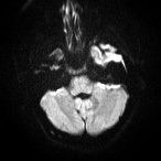 File:Cerebral venous infarction - hemorrhagic (Radiopaedia 81625-95505 Axial DWI 4).jpg