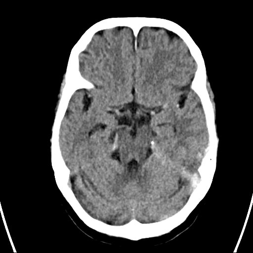 File:Cerebral venous infarction with hemorrhage (Radiopaedia 65343-74381 Axial non-contrast 8).jpg