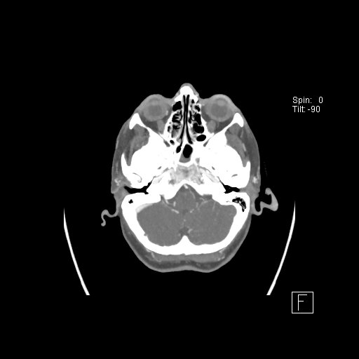 Cerebral venous infarction with hemorrhage (Radiopaedia 65343-74396 A 16).jpg