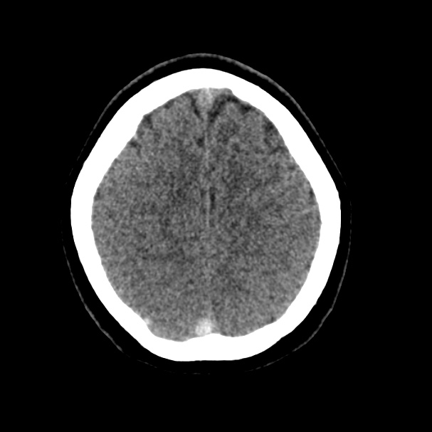 Cerebral venous sinus thrombosis (Radiopaedia 59224-66551 Axial non-contrast 38).jpg