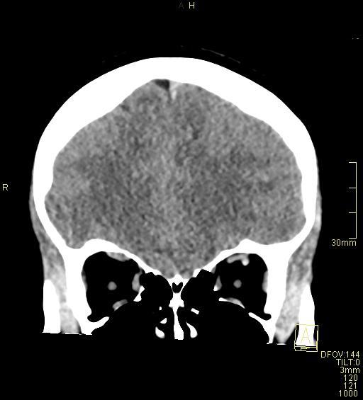 Cerebral venous sinus thrombosis (Radiopaedia 91329-108965 Coronal non-contrast 14).jpg