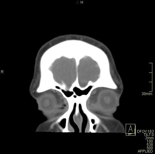 Cerebral venous sinus thrombosis (Radiopaedia 91329-108965 Coronal venogram 10).jpg
