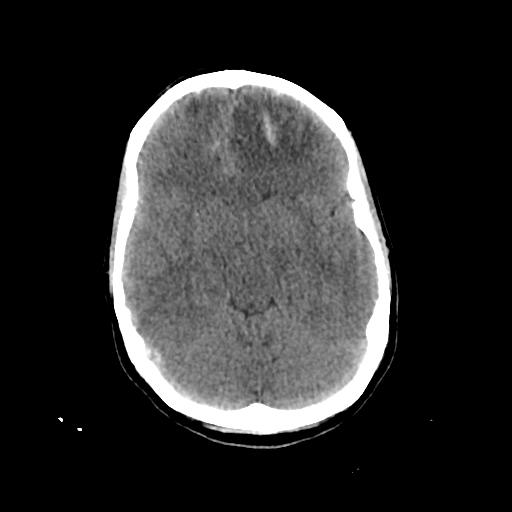 Cerebral venous throbmosis - hemorrhagic venous infarction (Radiopaedia 87318-103613 Axial non-contrast 65).jpg