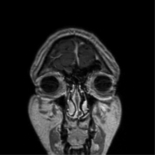 Cerebral venous thrombosis (Radiopaedia 38392-40469 Coronal T1 C+ 82).png