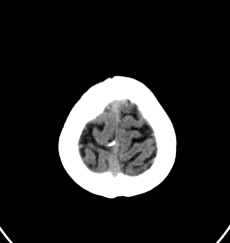 Cerebral venous thrombosis - CT only (Radiopaedia 41031-43778 Axial non-contrast 2).jpg