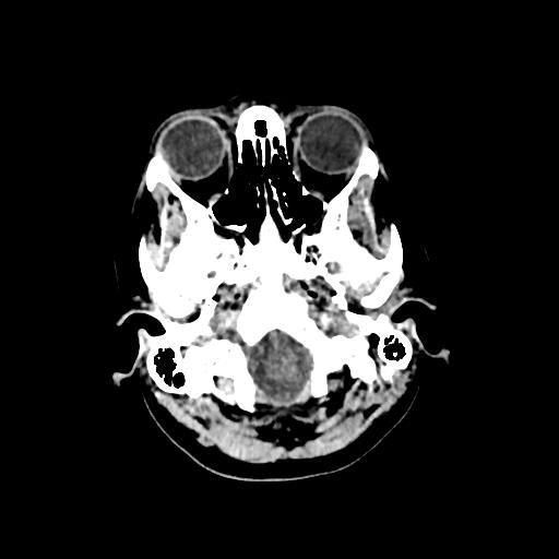 File:Cerebral venous thrombosis - hemorrhagic venous infarction (Radiopaedia 87318-103613 Axial 143).jpg