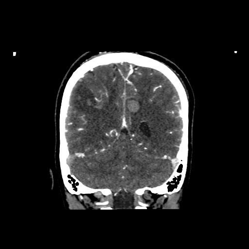 File:Cerebral venous thrombosis - hemorrhagic venous infarction (Radiopaedia 87318-103613 Coronal 16).jpg