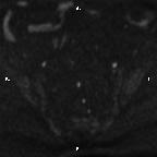 File:Cervical adenocarcinoma (Radiopaedia 65011-73985 Axial DWI 81).jpg