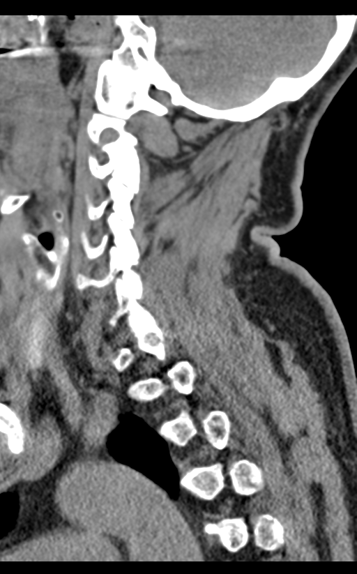 Cervical canal stenosis - OPLL and osteophytes (Radiopaedia 47329-51910 B 25).png