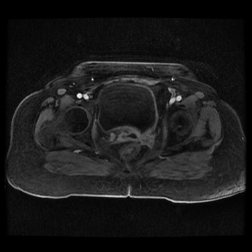 Cervical carcinoma (Radiopaedia 70924-81132 Axial T1 C+ fat sat 42).jpg