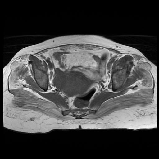 File:Cervical carcinoma (Radiopaedia 88010-104555 Axial T1 11).jpg