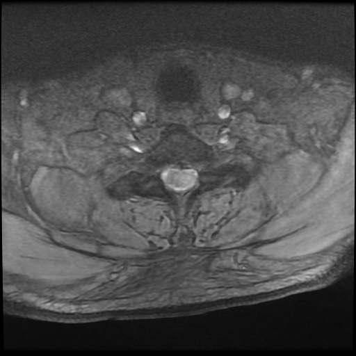 Cervical disc extrusion (Radiopaedia 59074-66364 F 50).jpg