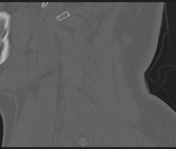 Cervical disc replacement (Radiopaedia 44025-47541 Sagittal bone window 17).png