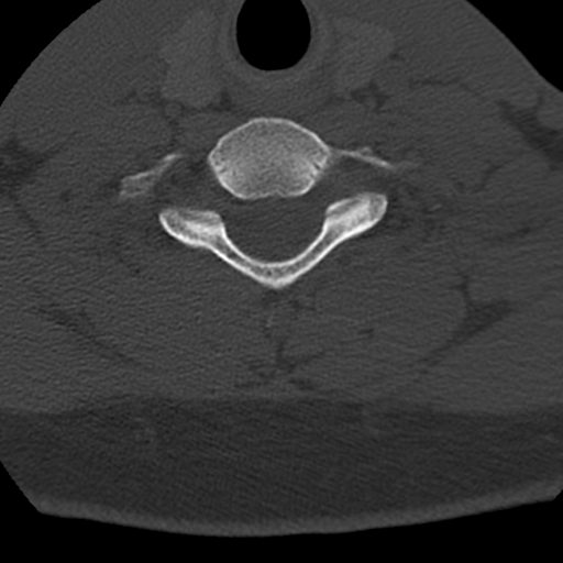 Cervical schwannoma (Radiopaedia 57979-64974 Axial bone window 37).png