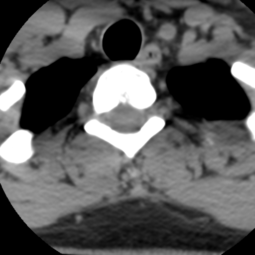Cervical schwannoma (Radiopaedia 57979-64974 Axial non-contrast 61).png