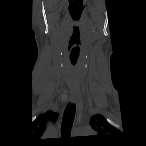 Cervical schwannoma (Radiopaedia 57979-64974 Coronal bone window 18).png