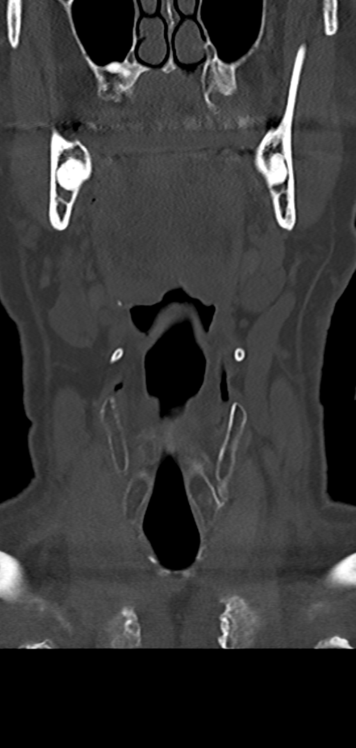 Cervical spine fracture - chalk stick (Radiopaedia 39116-41323 Coronal bone window 3).png