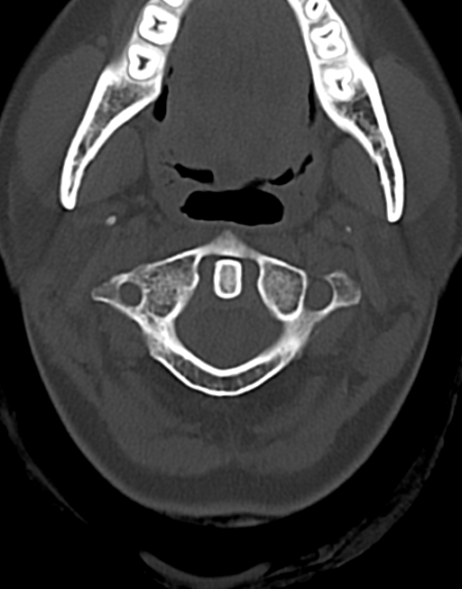 Cervical tuberculous spondylitis (Radiopaedia 39149-41365 Axial bone window 12).png