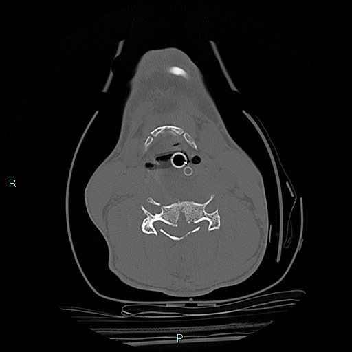 File:Cervical vertebral burst fracture (Radiopaedia 37420-39258 Axial bone window 30).jpg