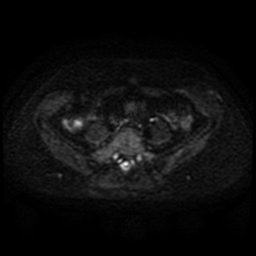 File:Cesarian section scar endometriosis (Radiopaedia 66520-75799 Axial DWI 26).jpg