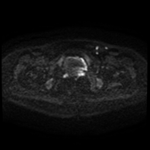 Cesarian section scar endometriosis (Radiopaedia 66520-75799 Axial DWI 96).jpg