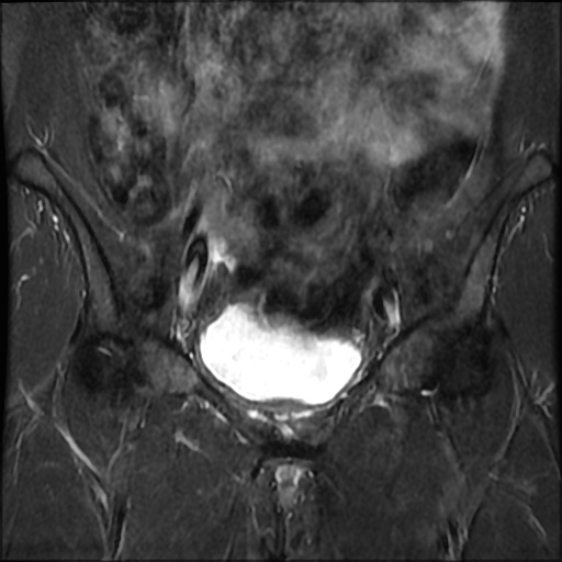 File:Cesarian section scar endometriosis (Radiopaedia 66520-75799 Coronal STIR 12).jpg