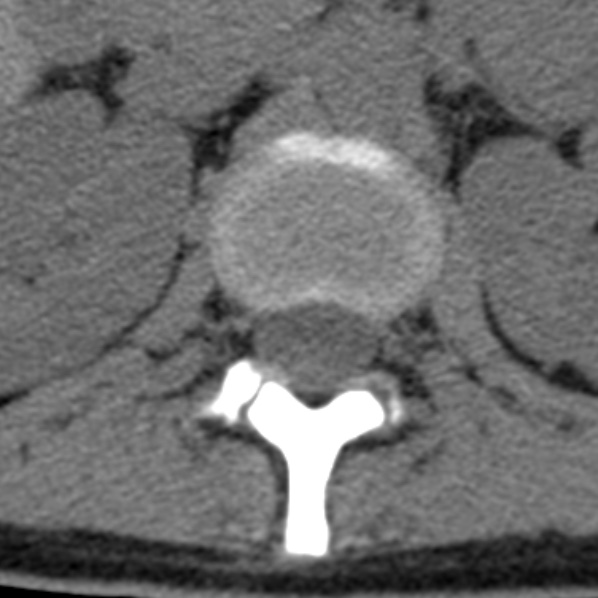 File:Chance fracture (Radiopaedia 36521-38081 Axial non-contrast 74).jpg