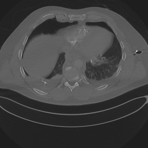 Chest multitrauma - aortic injury (Radiopaedia 34708-36147 Axial bone window 211).png