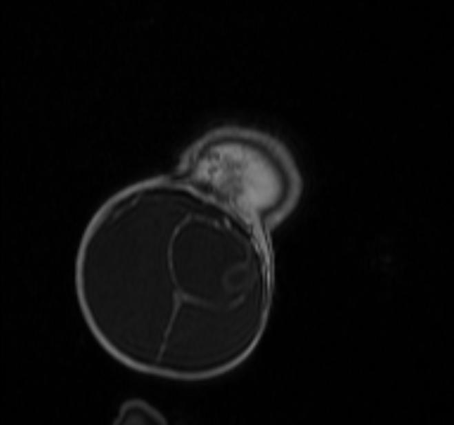 Chiari III malformation with occipital encephalocele (Radiopaedia 79446-92559 Coronal T1 C+ mpr 53).jpg