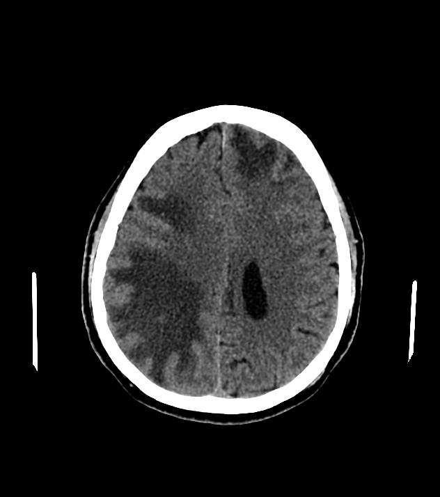 Cholangiocarcinoma with cerebral metastases (Radiopaedia 83519-98628 Axial non-contrast 45).jpg