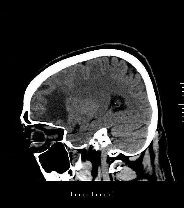 Cholangiocarcinoma with cerebral metastases (Radiopaedia 83519-98628 C 38).jpg