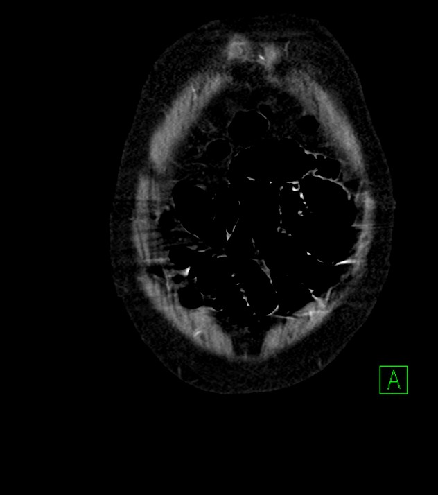 Cholangiocarcinoma with cerebral metastases (Radiopaedia 83519-98629 E 8).jpg