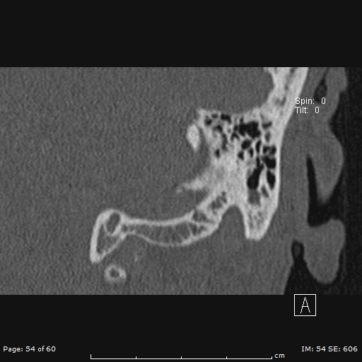 Cholesteatoma - external auditory canal (Radiopaedia 88452-105096 Coronal bone window 54).jpg