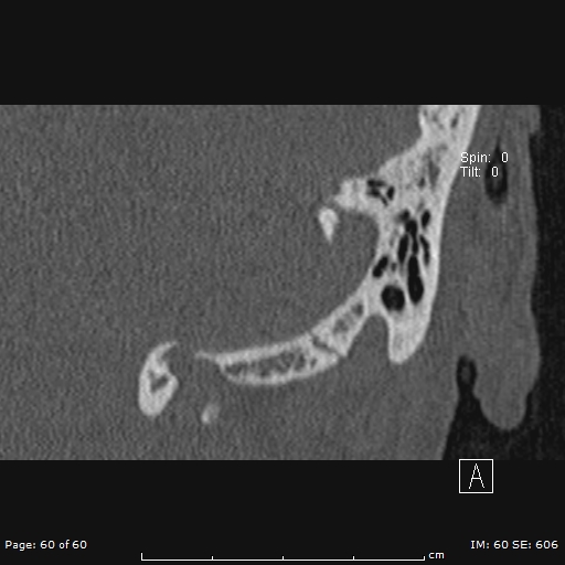 Cholesteatoma - external auditory canal (Radiopaedia 88452-105096 Coronal bone window 60).jpg