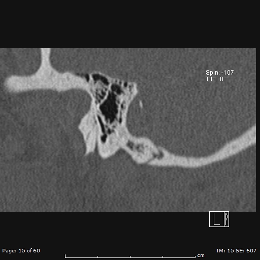 Cholesteatoma - external auditory canal (Radiopaedia 88452-105096 Sagittal bone window 15).jpg