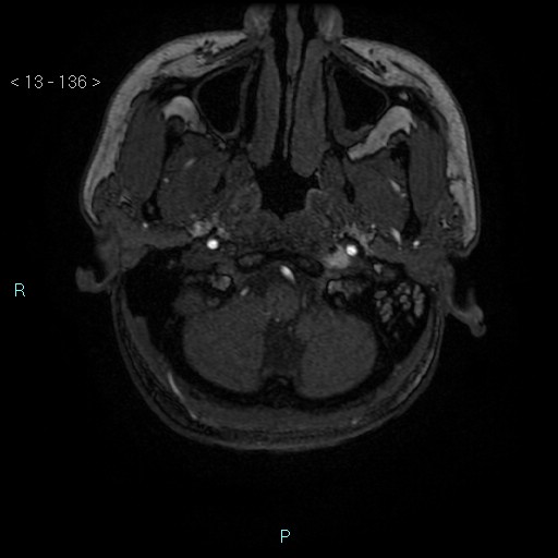 Cholesterol granuloma of the petrous apex (Radiopaedia 64358-73140 Axial TOF 3D 65).jpg