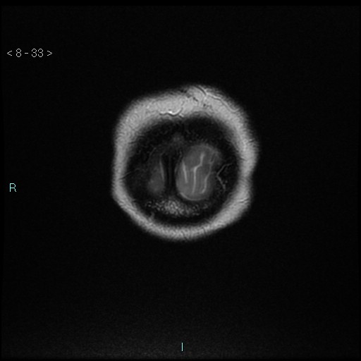 File:Cholesterol granuloma of the petrous apex (Radiopaedia 64358-73140 Coronal T2 33).jpg