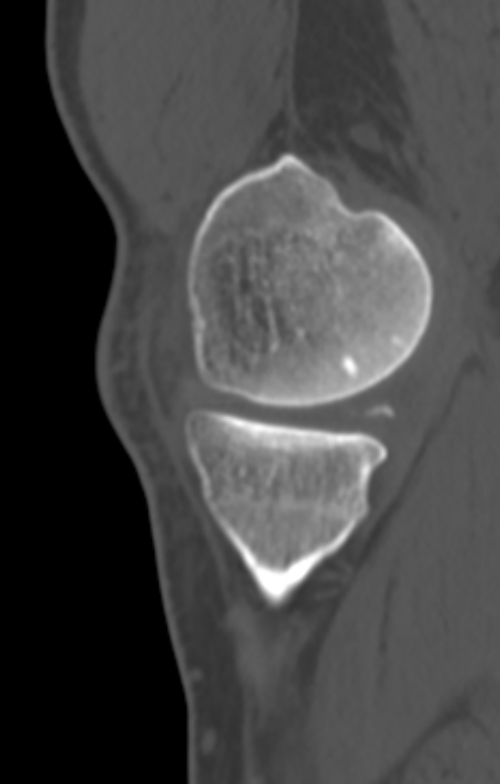 Chondrocalcinosis (Radiopaedia 82862-97173 Sagittal bone window 12).jpg
