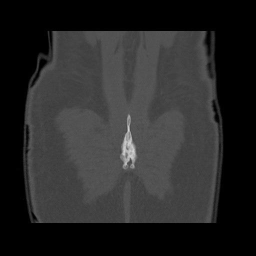 Chondrosarcoma of iliac wing (Radiopaedia 63861-72599 Coronal bone window 105).jpg