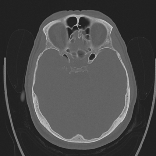 File:Chondrosarcoma of skull base- grade II (Radiopaedia 40948-43653 Axial bone window 17).png
