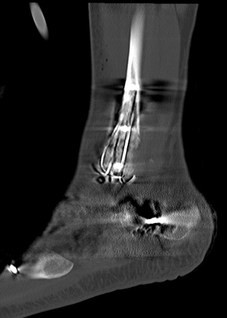 Chopart fracture (Radiopaedia 35347-36861 Sagittal bone window 57).jpg