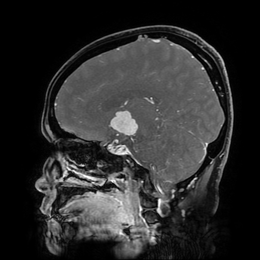 File:Chordoid glioma of third ventricle (Radiopaedia 91612-109340 F 120).jpg