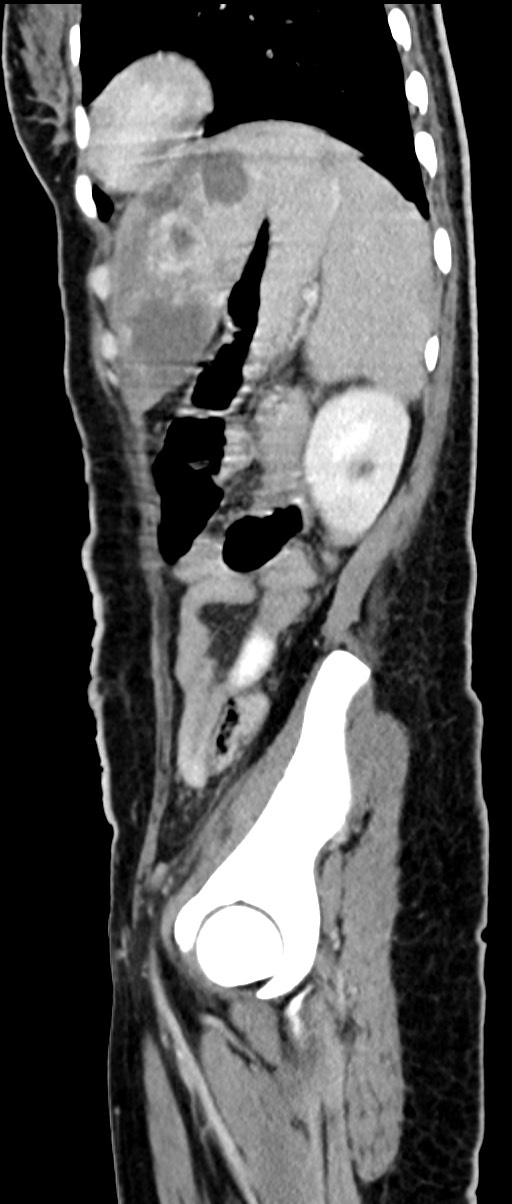Choriocarcinoma liver metastases (Radiopaedia 74768-85766 C 64).jpg