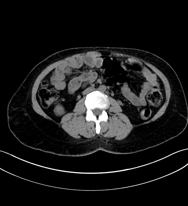 Chromophobe renal cell carcinoma (Radiopaedia 84290-99582 Axial non-contrast 74).jpg