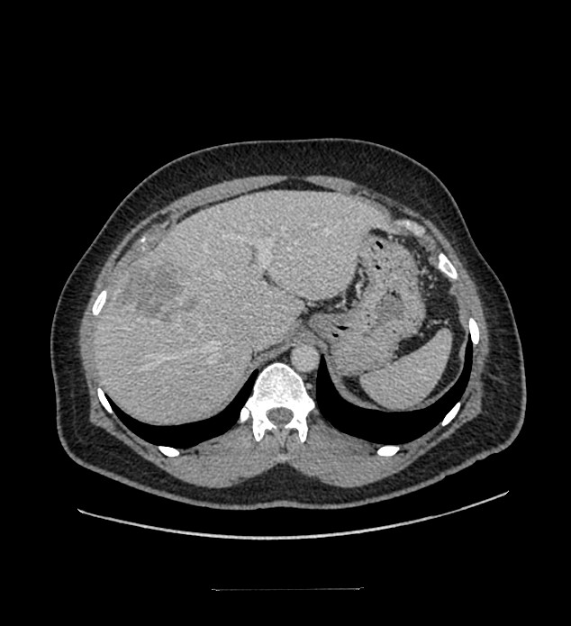 Chromophobe renal cell carcinoma (Radiopaedia 84337-99644 C 29).jpg