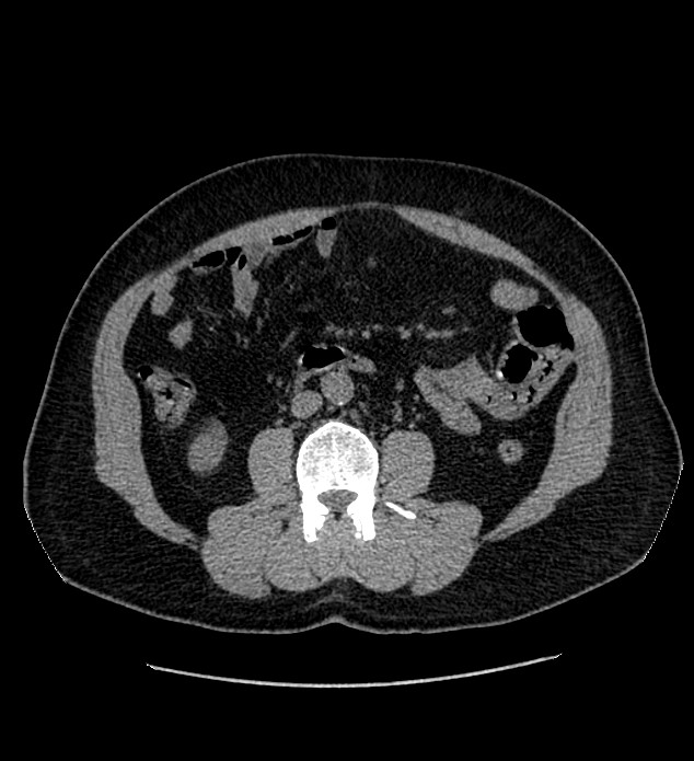 Chromophobe renal cell carcinoma (Radiopaedia 84337-99693 Axial non-contrast 75).jpg