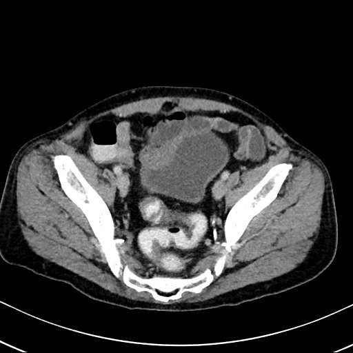 Chronic appendicitis complicated by appendicular abscess, pylephlebitis and liver abscess (Radiopaedia 54483-60700 B 122).jpg
